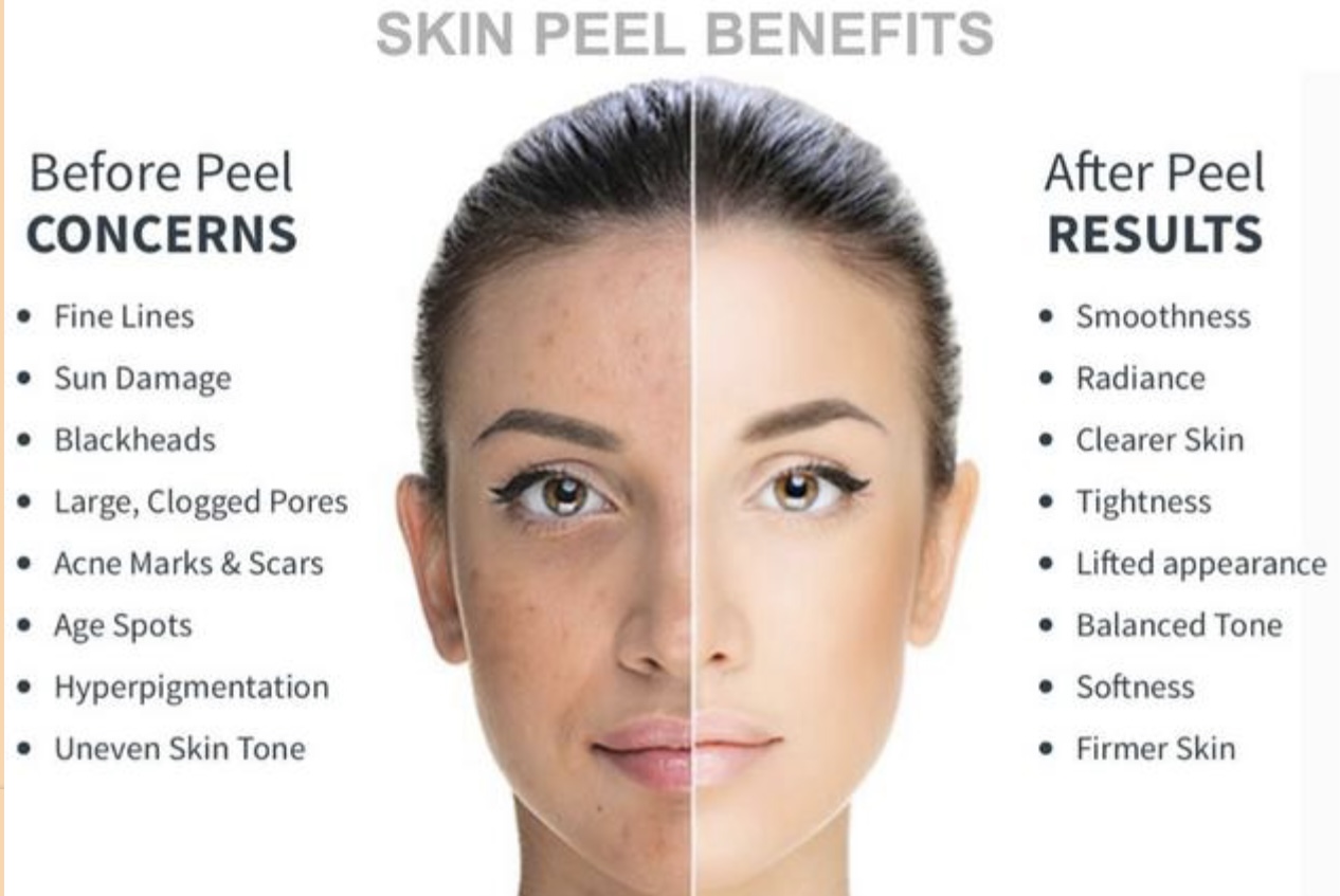 Chemical Peel